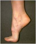 DORSIFLEXION: Movement of the big toe towards the shin